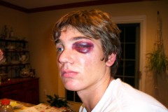 young man with a shiner